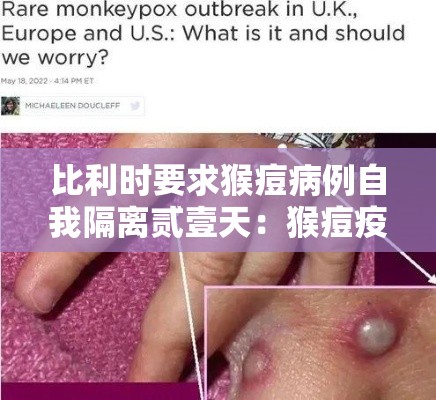 比利时要求猴痘病例自我隔离贰壹天:猴痘疫情有多严重中国需要紧张吗壹 比利时要求猴痘病例自我隔离贰壹天:猴痘疫情有多严重中国需要紧张吗壹