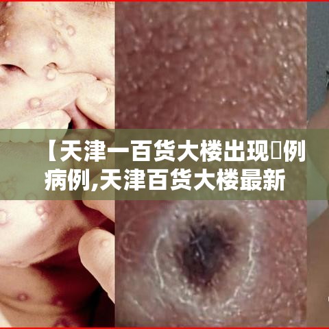 【天津一百货大楼出现無例病例,天津百货大楼最新消息今天】